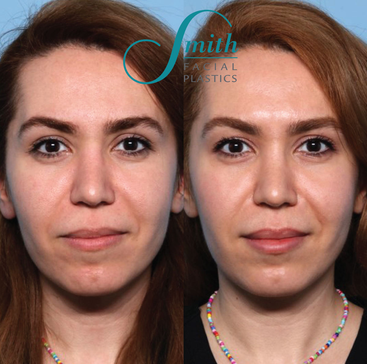Dermal Filler Before and After Results in Columbus by Smith Facial Plastics