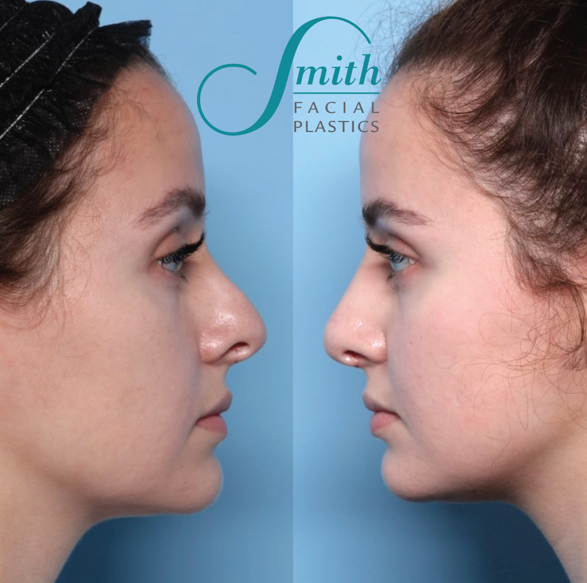 Revision Rhinoplasty Before and After Results in Columbus by Smith Facial Plastics