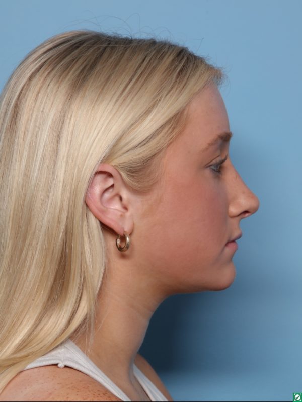 Rhinoplasty