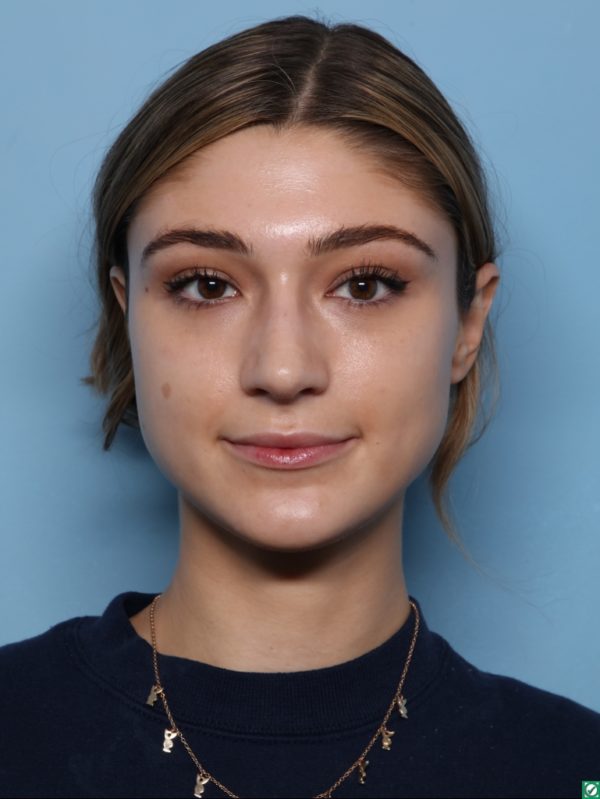 Rhinoplasty