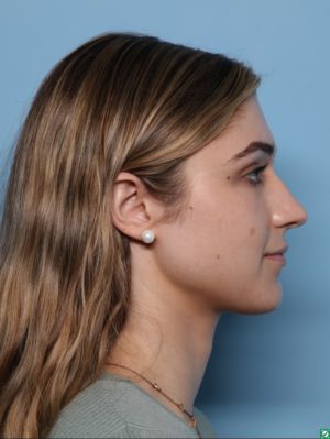 Rhinoplasty