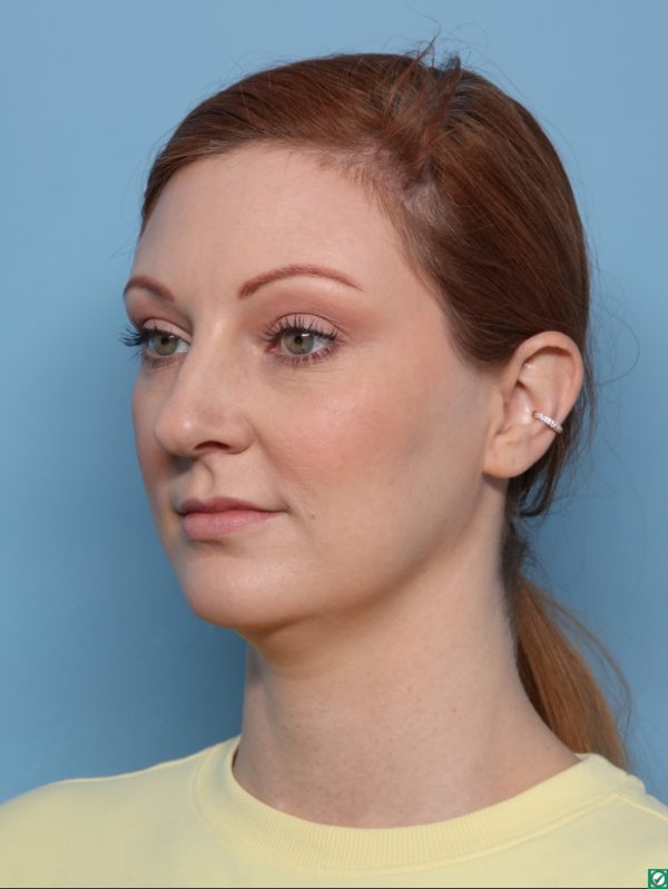 Rhinoplasty