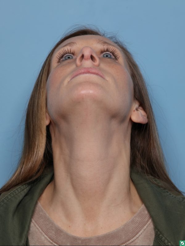 Rhinoplasty