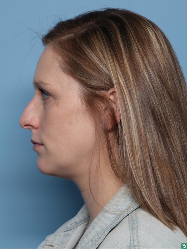 Rhinoplasty