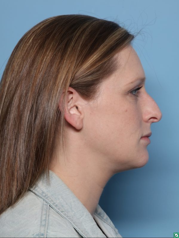 Rhinoplasty