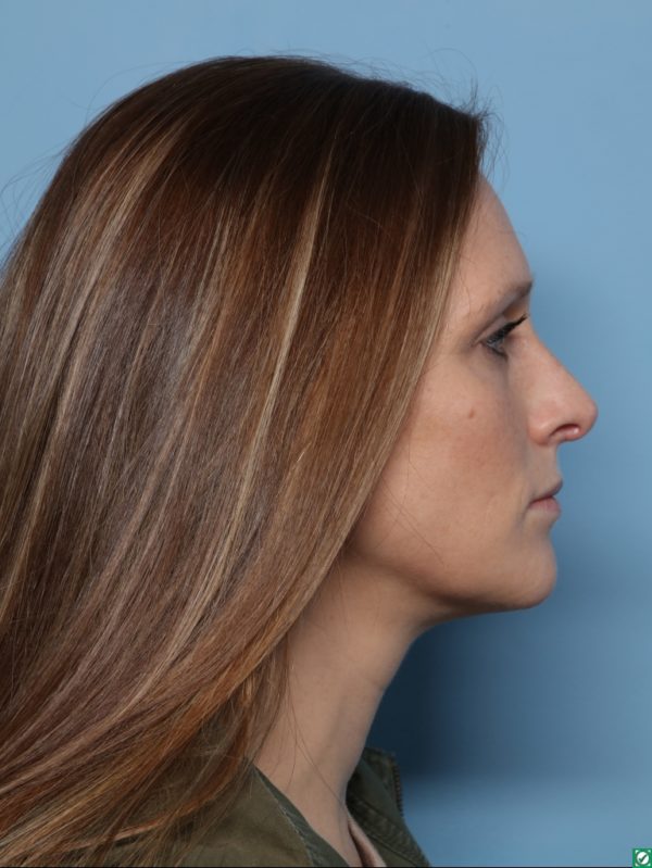 Rhinoplasty