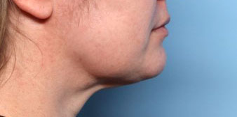 Neck Liposuction