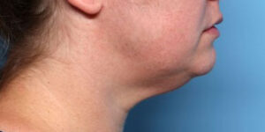 Neck Liposuction