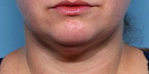 Neck Liposuction