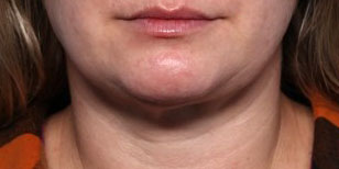 Neck Liposuction