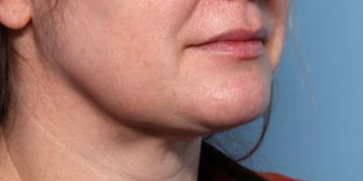 Neck Liposuction