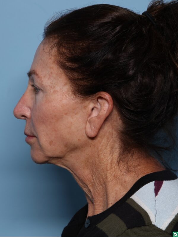 Facial Fat Grafting & TRL Laser