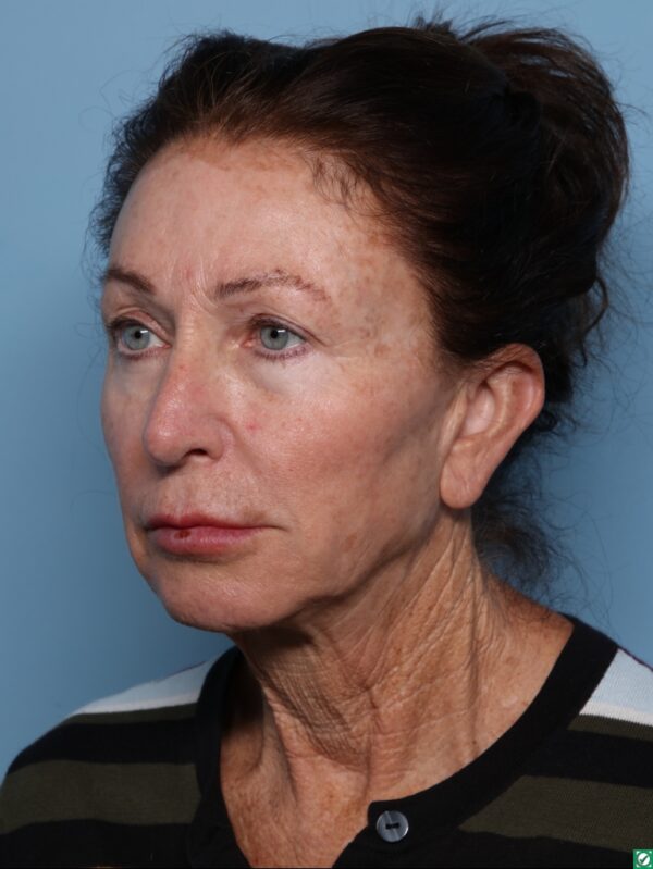 Lipo Transfers/Facial Fat Grafting