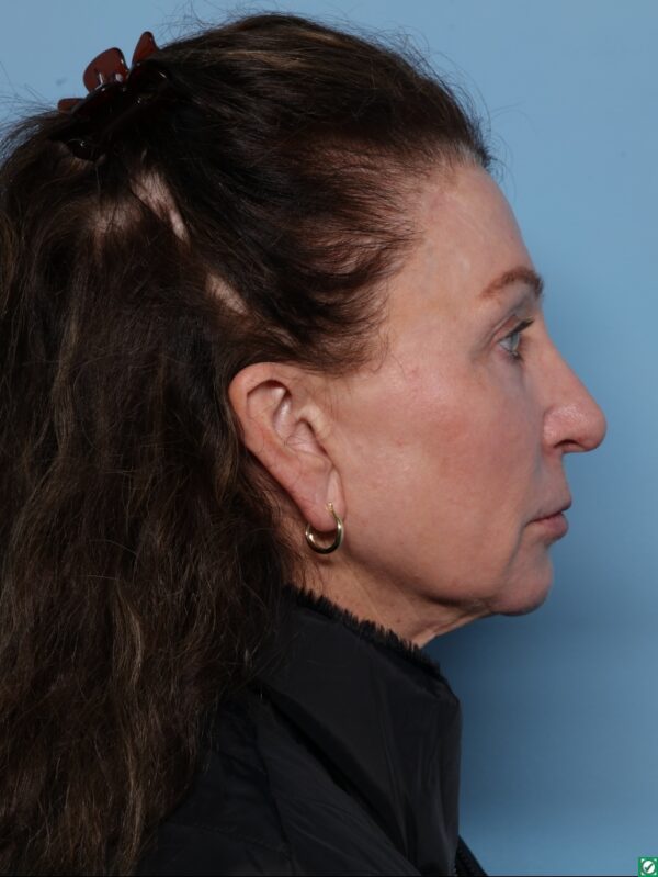 Lipo Transfers/Facial Fat Grafting