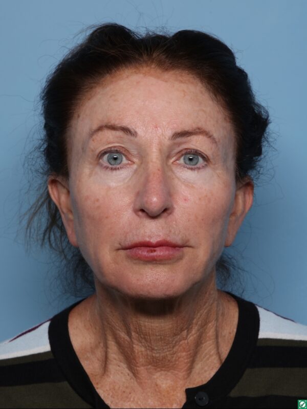 Lipo Transfers/Facial Fat Grafting