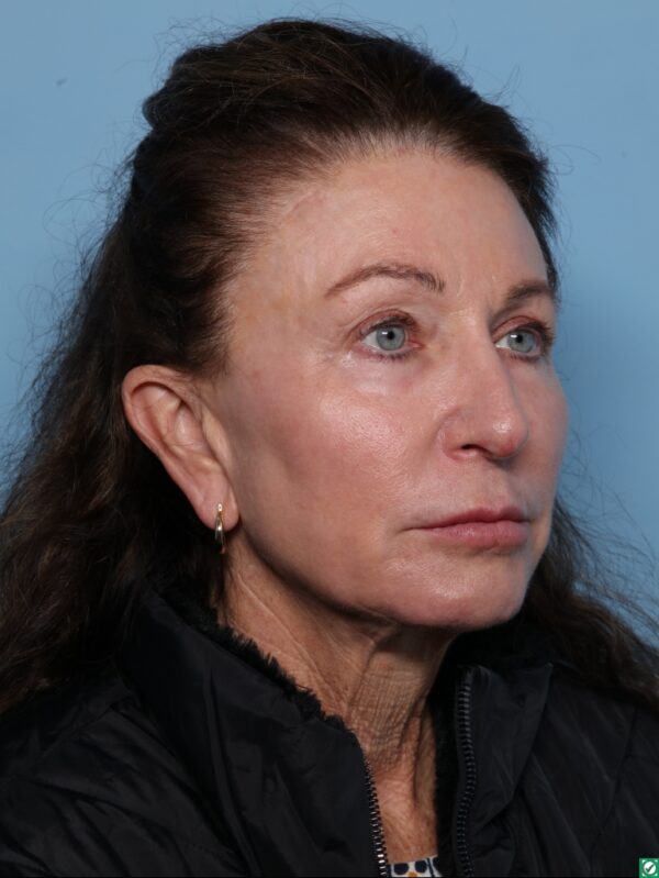 Lipo Transfers/Facial Fat Grafting