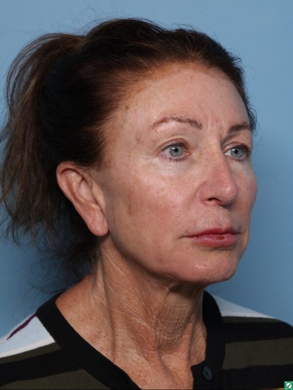 Lipo Transfers/Facial Fat Grafting