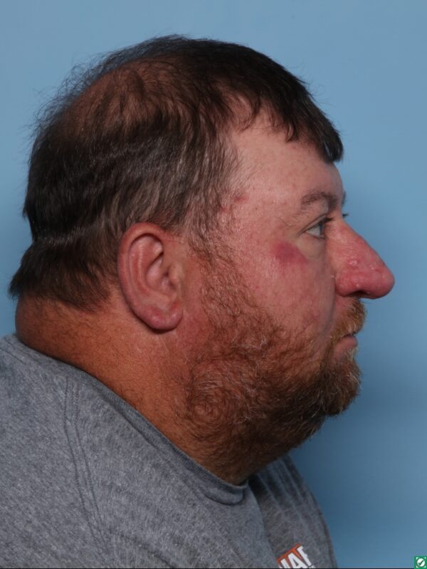 Rhinophyma Excision