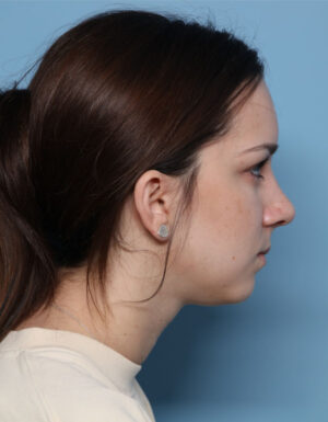 Rhinoplasty