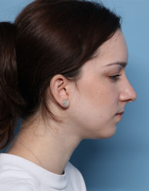 Rhinoplasty