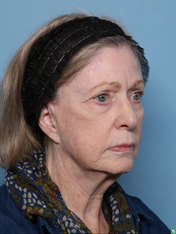 Lipo Transfers/Facial Fat Grafting
