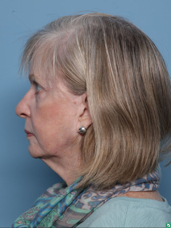 Lipo Transfers/Facial Fat Grafting