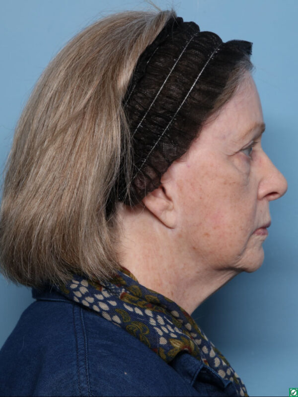 Lipo Transfers/Facial Fat Grafting