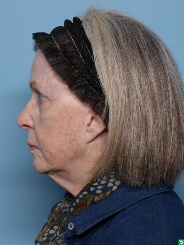 Lipo Transfers/Facial Fat Grafting