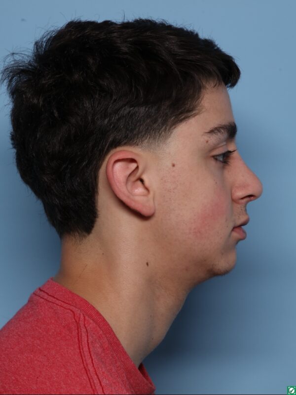 Rhinoplasty