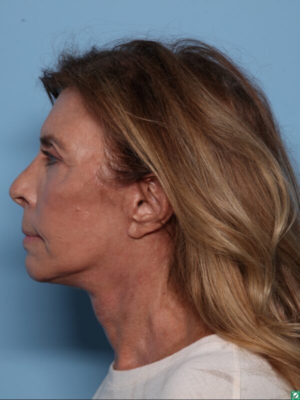 Facelift