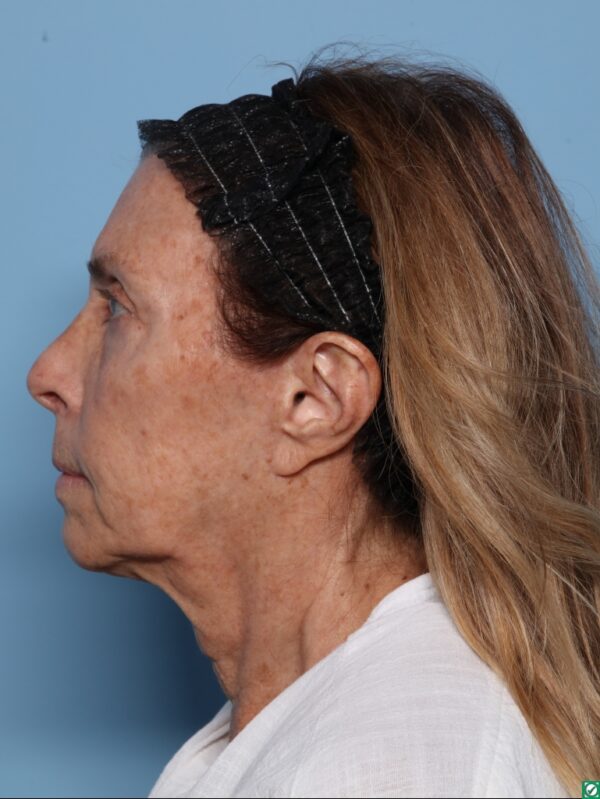 Facelift