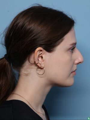 Rhinoplasty