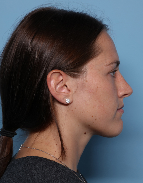 Rhinoplasty