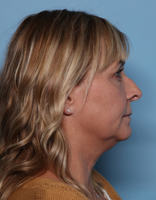 Rhinoplasty