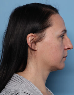 Rhinoplasty