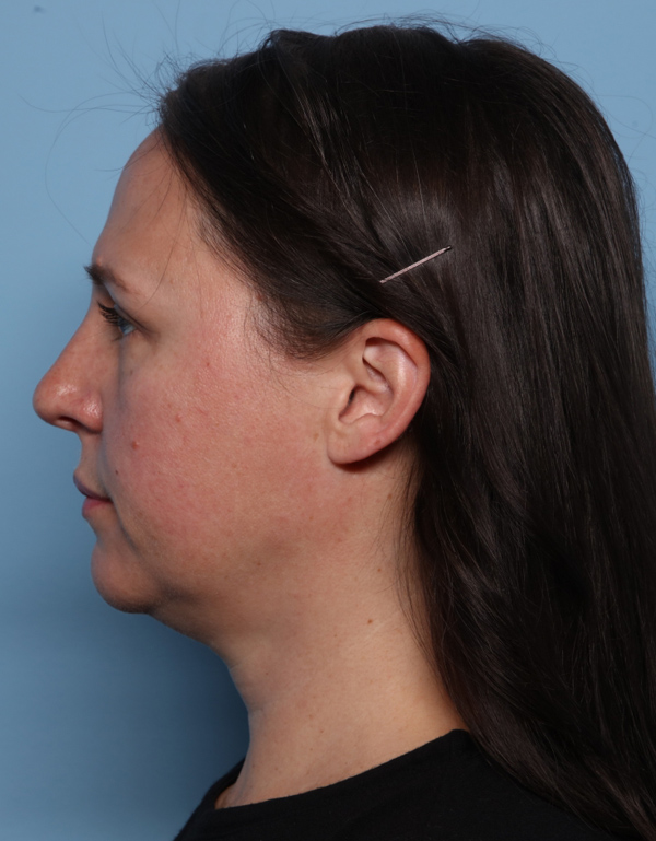 Rhinoplasty