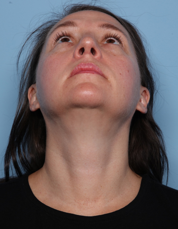 Rhinoplasty