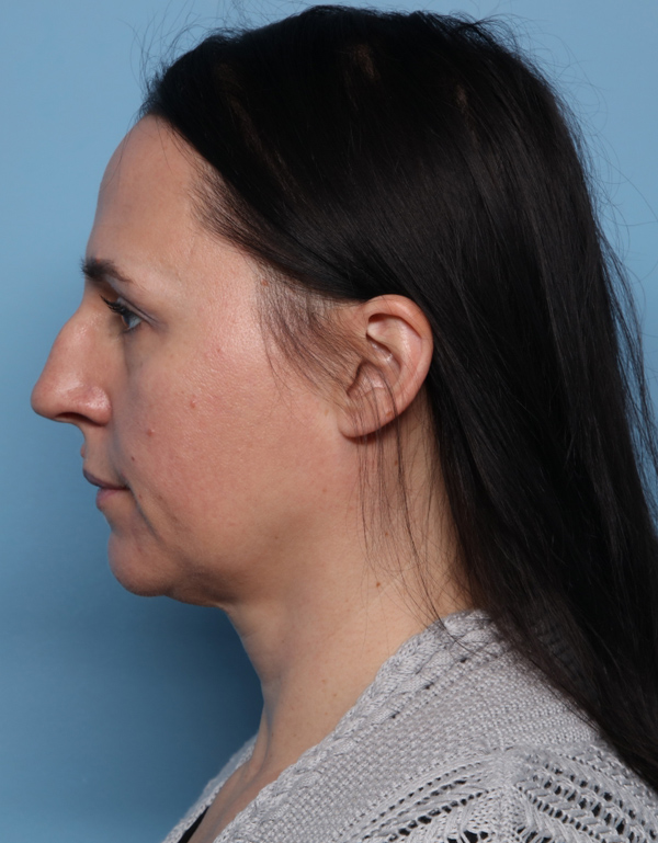 Rhinoplasty