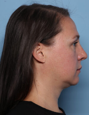 Rhinoplasty