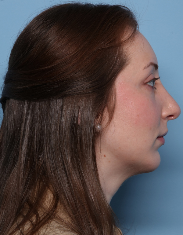 Rhinoplasty