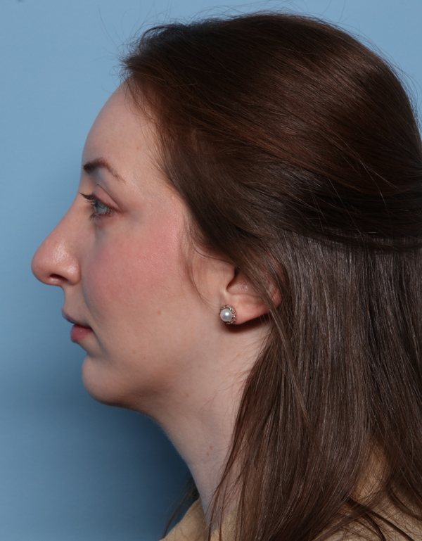 Rhinoplasty