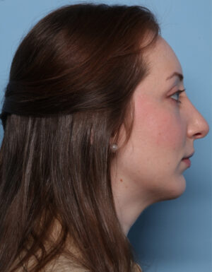 Chin Augmentation