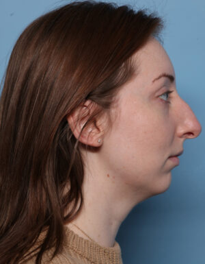 Chin Augmentation