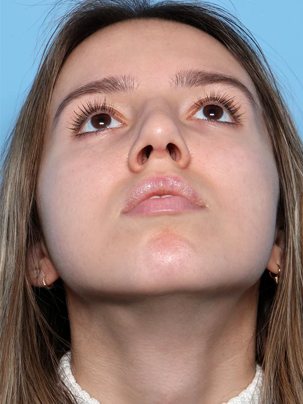 Rhinoplasty