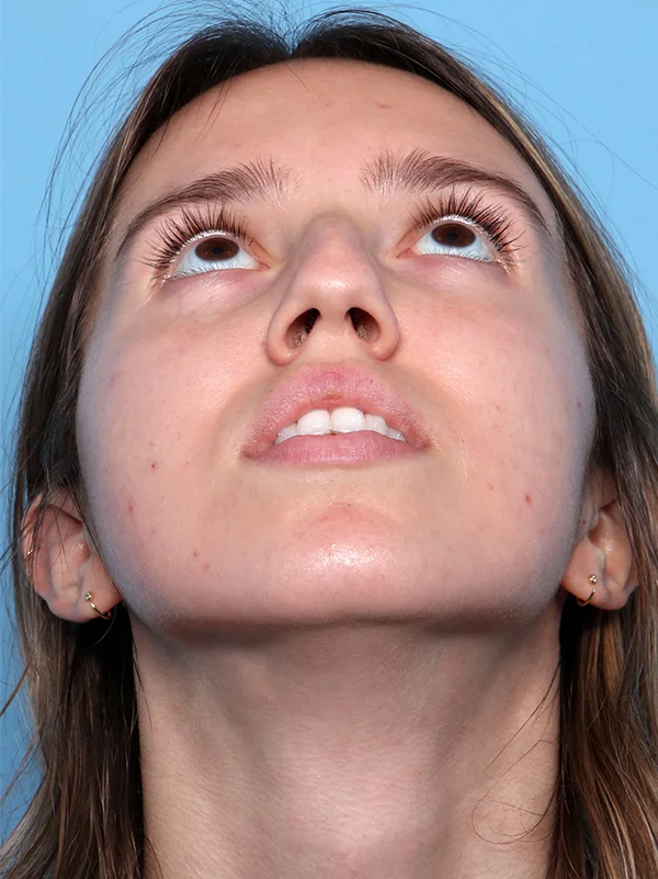 Rhinoplasty