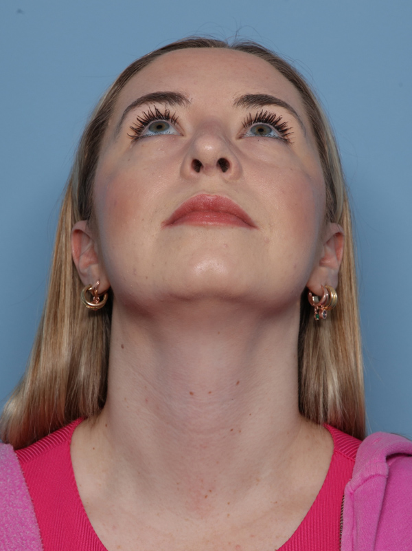 Rhinoplasty