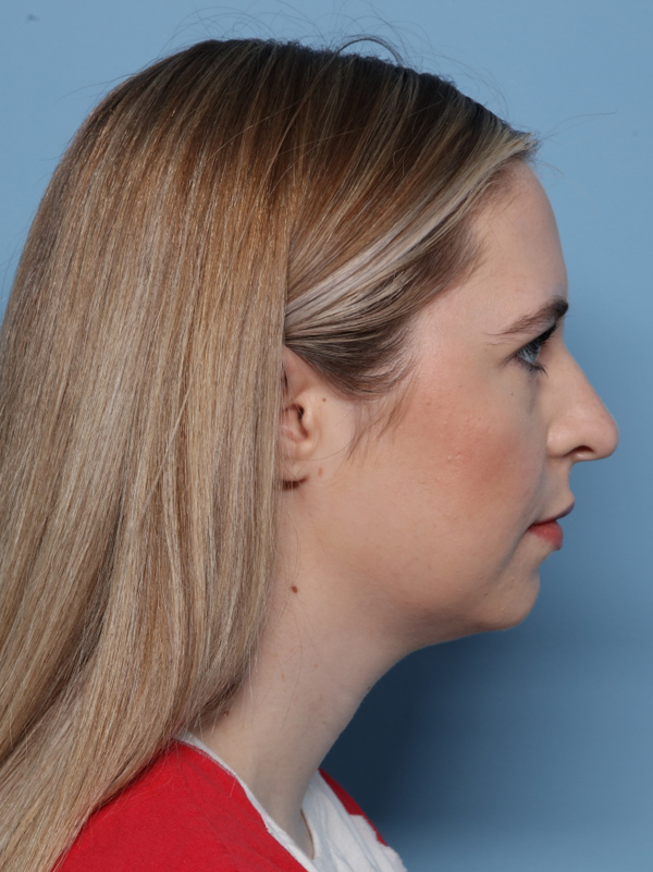 Rhinoplasty