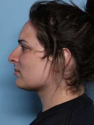 Rhinoplasty