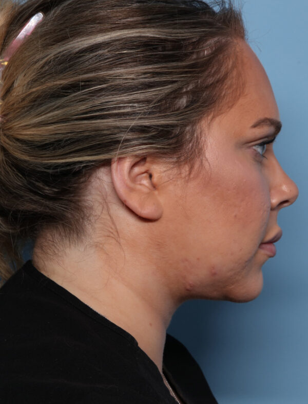 Neck Liposuction