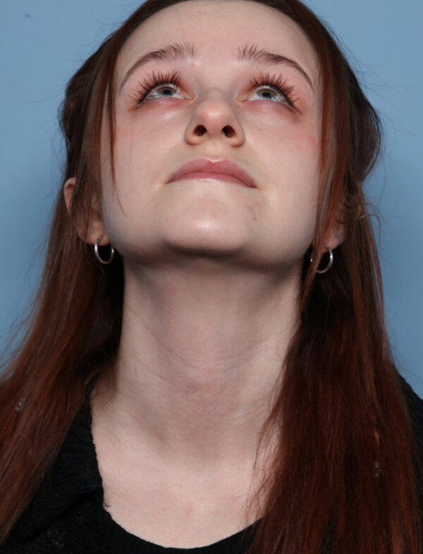 Rhinoplasty